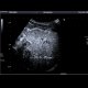 Focal nodular hyperplasia, CEUS: US - Ultrasound